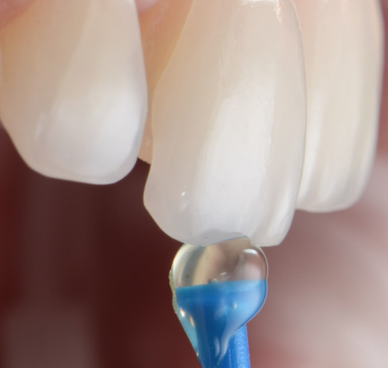 Root Canal Treatment